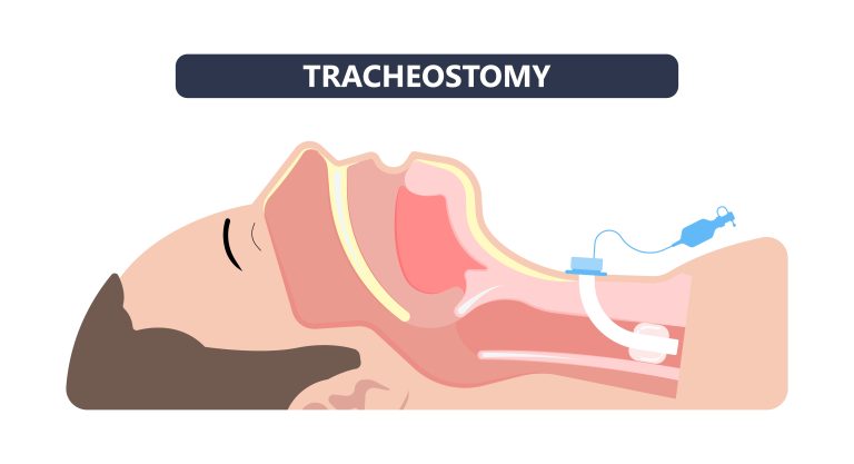 An illustration of a man undergoing tracheostomy