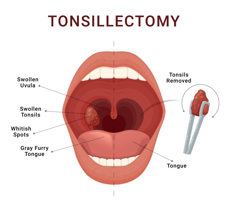 An illustration of tonsillectomy, removal of tonsils surgery
