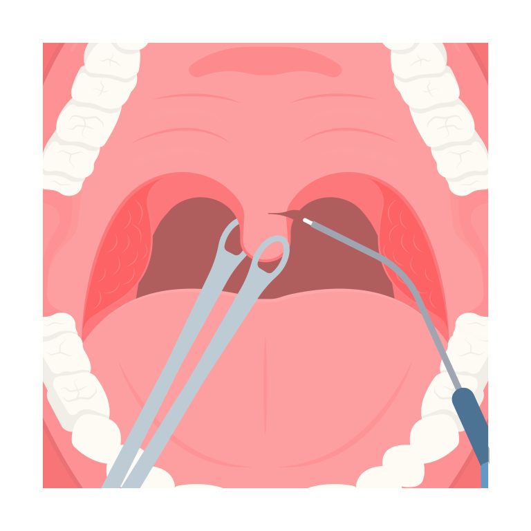 Uvulopalatopharyngoplasty (UPPP). treatment for sleep apnea by removal of soft tissue in the throat
