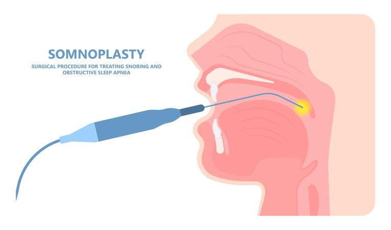 an illustration of somnoplasty, surgical procedure for treating sleep apnea, in particular obstructive sleep apnea (osa)