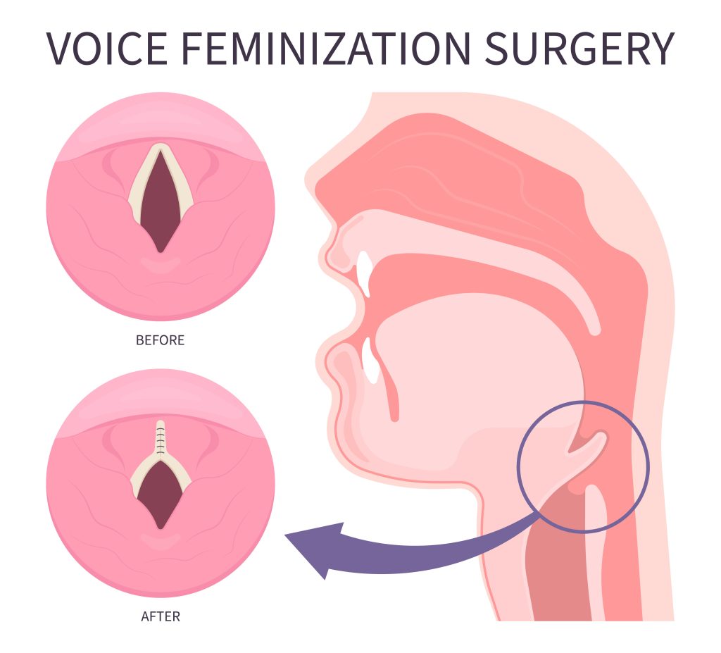 Medical anatomy for Voice Feminization Surgery male to female of Adam's procedure face speech estrogen exercise affirming care